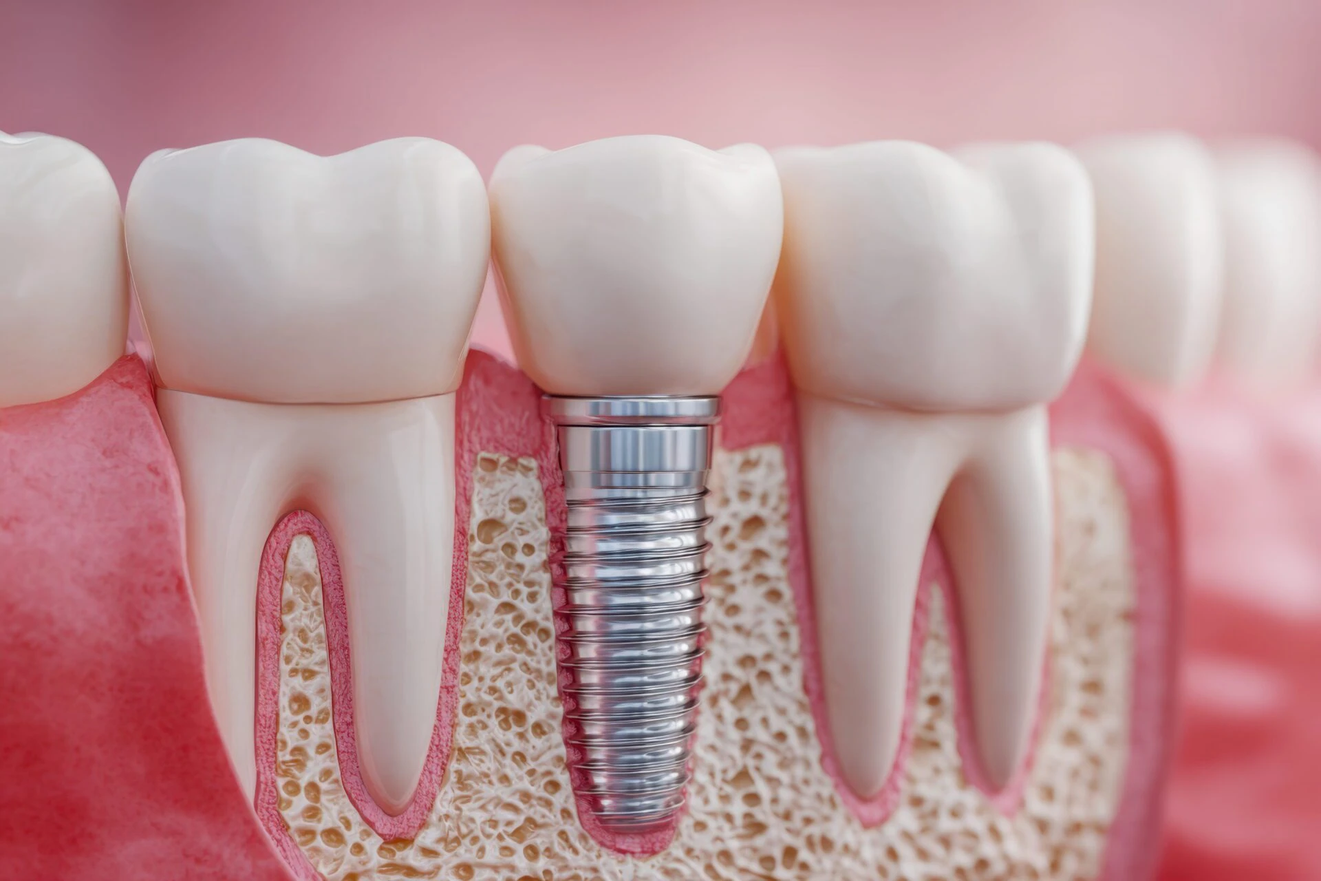 Dental Implants in Pinecrest, FL
