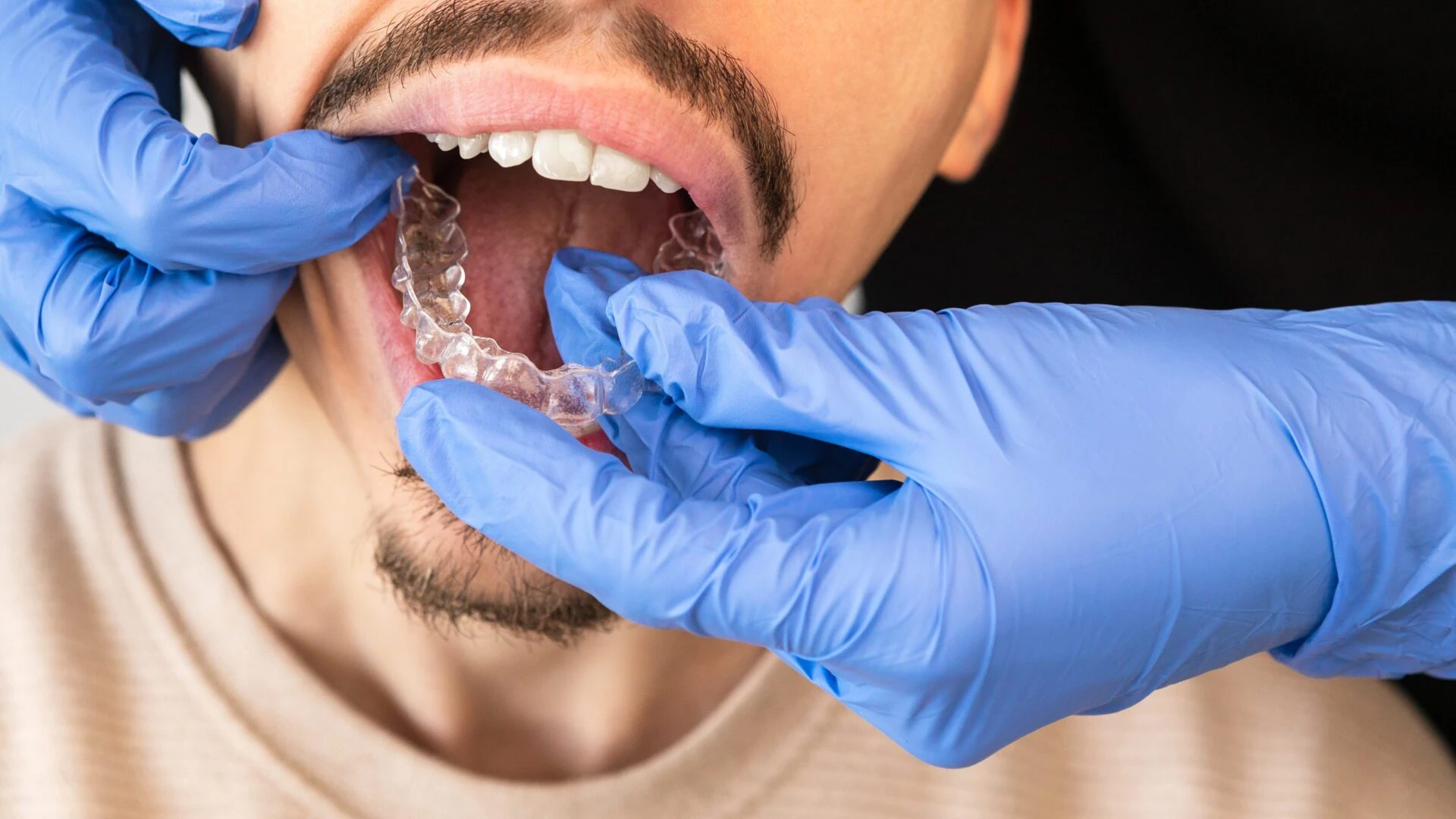 Invisalign1 Teeth case at Pine Crest Family Dental