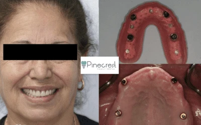 Maxillary Implant Overdenture Case in Pinecrest, FL