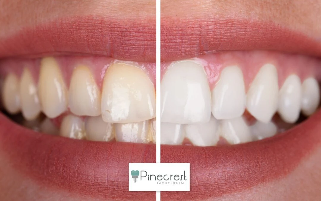 Teeth Whitening in Pinecrest